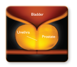 Enlarged Prostate
